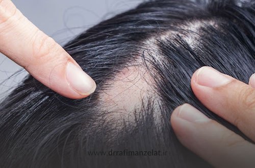 ریزش مو سکه ای؛ علائم، علل و انواع آلوپسی آره آتا