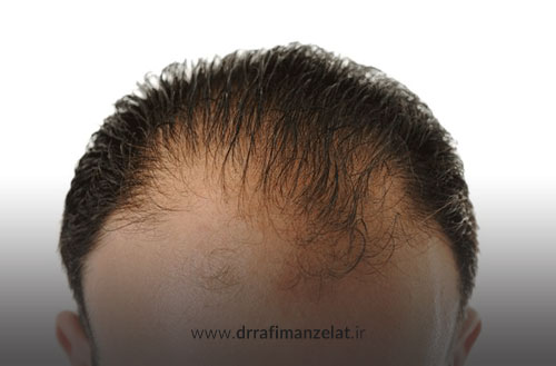 علل ریزش مو در مردان؛ راهنمای کامل تشخیص و درمان