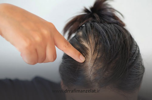 ریزش مو در زنان؛ بررسی علل، انواع و روش های درمان