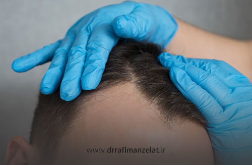 درمان ریزش مو؛ برای قطع ریزش مو چه کار کنیم؟