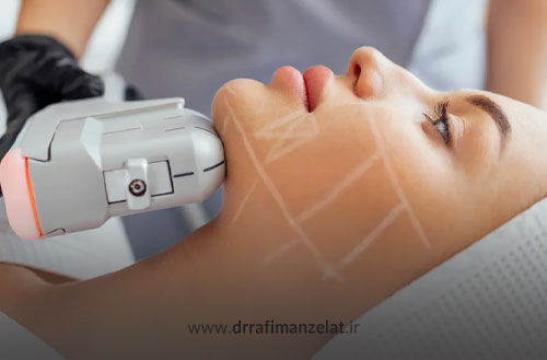 هایفوتراپی غبغب؛ از بین بردن غبغب با دستگاه هایفو