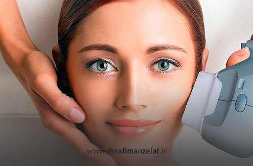 هایفوتراپی برای لک صورت؛ درمان لک صورت با هایفو