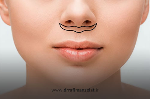 عمل سانترال لب؛ مزایا، ماندگاری و هزینه لیفت سانترال لب
