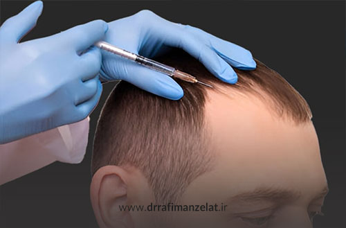 تزریق هیر فیلر در کلینیک آپادانا؛ معرفی برندهای اصل + قیمت 1404