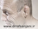هماتوم یا شکستگی لاله گوش چیست ؟