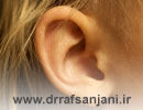 اتواسکلروز گوش چیست التهاب گوش چسبنده