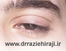 علت و نحوه درمان برخی از مشکلات و اختلالات پلک چشم