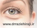 درمان پف و تورم زیر چشم با لیزر درمانی