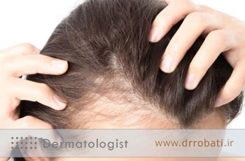 درباره تشخیص، علت و نحوه درمان ریزش مو بیشتر بدانید
