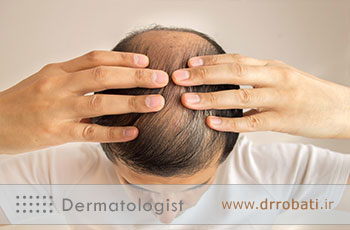 کاشت مو برای چه کسانی مناسب نیست؟