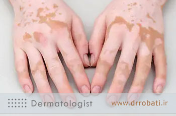 لکودرما چیست؟ | علائم، تفاوت با پیسی و روش های درمان لکودرما