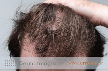 ریزش مو تلوژن افلوویوم؛ آشنایی با علائم، علت و انواع تلوژن افلوویوم