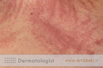 درماتوگرافی چیست؟ علت، علائم و درمان قطعی درماتوگرافی پوستی