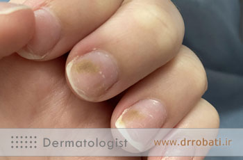 قارچ ناخن؛ علائم، درمان سریع + قویترین پماد ضد قارچ ناخن