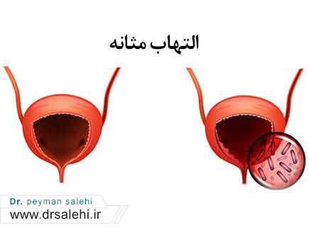 التهاب مثانه یا سیستیت