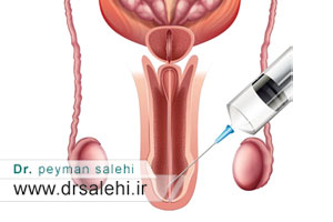 پی آر پی اختلال نعوظ چیست؟ | اثرگذاری درمان اختلال نعوظ با prp