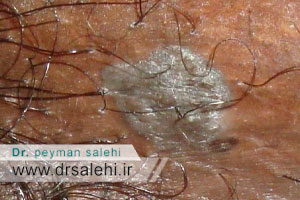 زگیل تناسلی مردان چیست؟ | خطرات زگیل تناسلی مردان