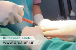 تزریق ژل به آلت مردانه برای افزایش سایز توسط پزشک متخصص
