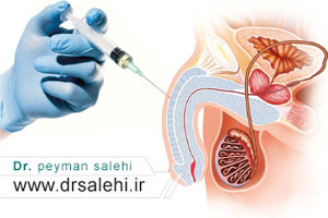 پی آر پی ناتوانی جنسی در اصفهان برای بهبود عملکرد جنسی