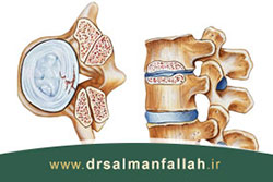 تنگی کانال نخاعی چیست و چگونه درمان می شود؟