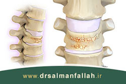 تشخیص و درمان شکستگی ستون فقرات