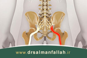 سیاتیک چگونه تشخیص داده می شود؟