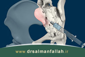 درمان التهاب مفصل ساکروایلیاک با تزریق در مفصل ساکروایلیاک