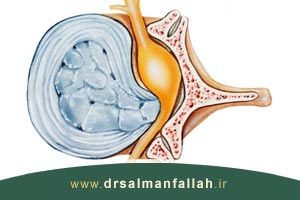 درمان بالجینگ دیسک کمر با روشهای سرپایی طب فیزیکی