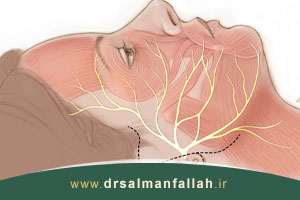 فلج عصب صورت (فلج بلز) به چه وضعیتی گفته میشود؟