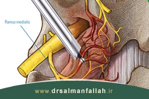 نورولیز مفاصل فاست چگونه انجام میشود؟