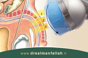 آیا اختلال نعوظ با شاک ویو تراپی درمان می شود؟