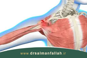 علائم، علل و روشهای پیشگیری از سندروم گیر افتادگی شانه