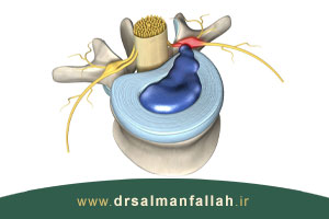 چه عواملی باعث پارگی دیسک کمر می شود؟