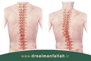 علل و درمان اسکولیوز یا انحراف جانبی ستون فقرات