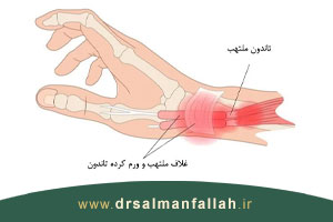 سندرم دکرون چیست و چه علل و علائمی دارد؟