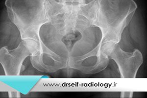 بررسی کوتاهی اندام تحتانی با رادیوگرافی اسكنوگرام