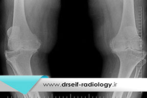 رادیوگرافی تری جوینت برای تشخیص انحراف زانو ها