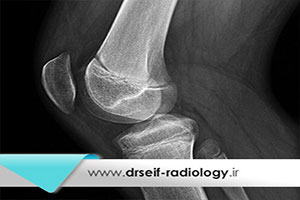 کاربرد رادیوگرافی زانو