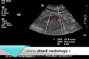 سونوگرافی رنگی شریان های کلیه