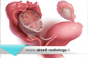 سندروم تخمدان پلی کیستیک چگونه با سونوگرافی تشخیص داده میشود؟