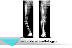 رادیوگرافی alignment view در چه شرایطی انجام میشود؟