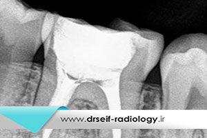 انواع روش های رادیولوژی تک دندان