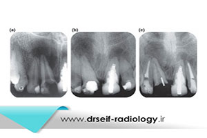 رادیوگرافی تک دندان یا پری اپیکال