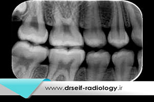 مراحل انجام رادیوگرافی بایت وینگ