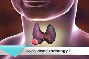 روش های تصویربرداری تشخیص سرطان تیروئید