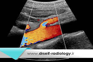 سونوگرافی کالرداپلر عروق چیست؟