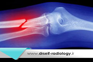 رادیوگرافی شکستگی استخوان چگونه انجام میشود؟