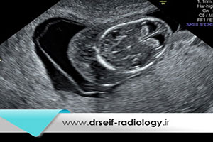 تشخیص سندروم داون در بارداری با سونوگرافی