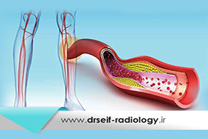 بیماری DVT چطور تشخیص داده میشود؟