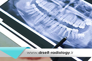آیا تشخیص آبسه دندان با رادیولوژی امکان پذیر است؟